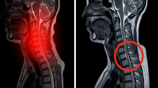 How Cervical Myelopathy Treatment Prevents Disability Through Timely Intervention And Neurological Preservation